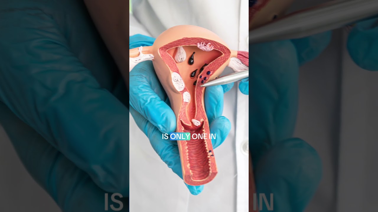 FAQ: Will My Fibroid Turn Cancerous? | Dr Usha Kiran | Emirates Specialty Hospital