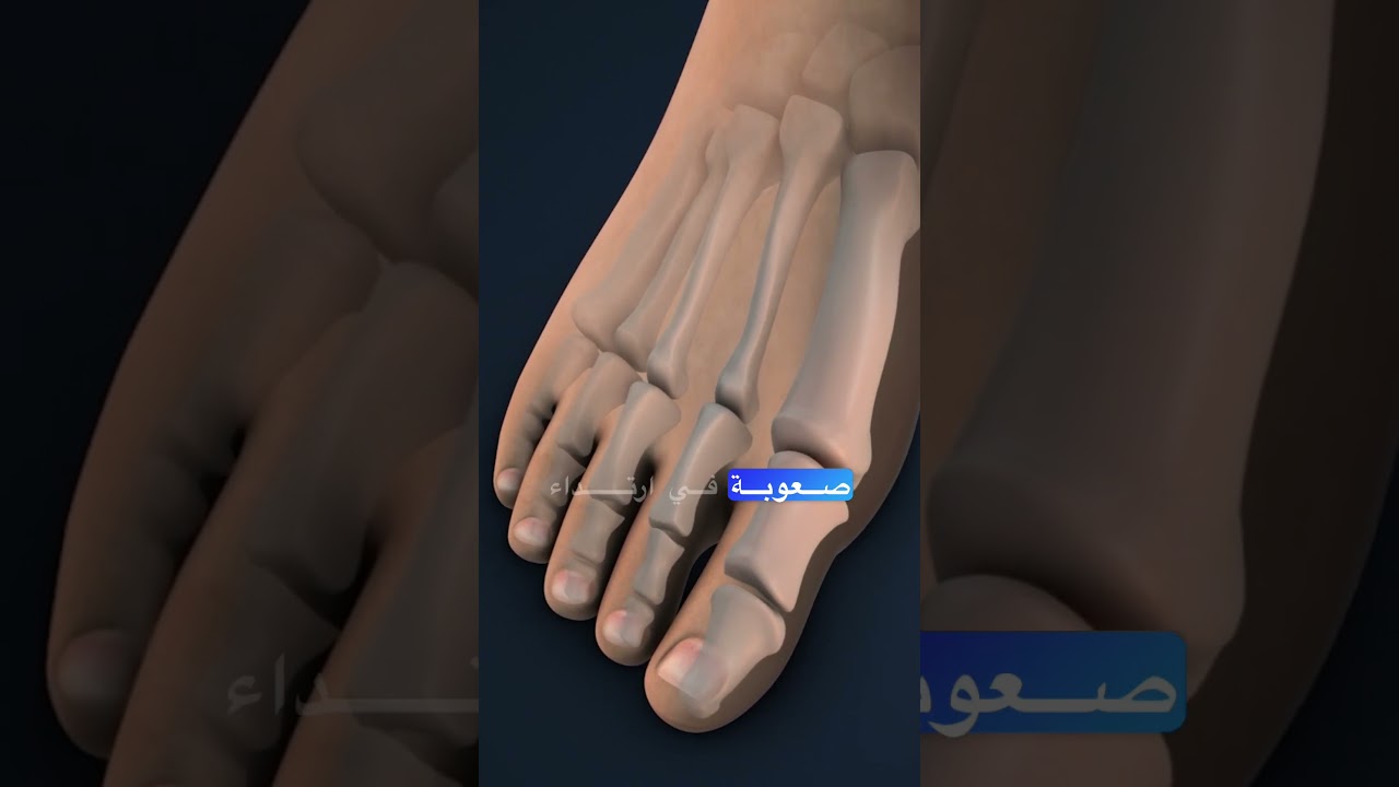 Dr. Ahmad Bashir Yagan | Bunions Treatment | Emirates Hospital Day Surgery, Abu Dhabi