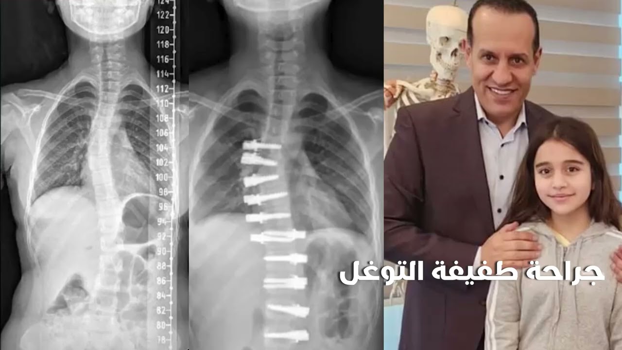 جراحة الجنف الأكثر تطوراً في الشرق الأوسط | في دبي، الإمارات العربية المتحدة | الدكتور فراس الحسبان