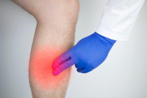 varicose vein treatment