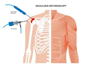 Shoulder Arthroscopy Surgery Dubai Best