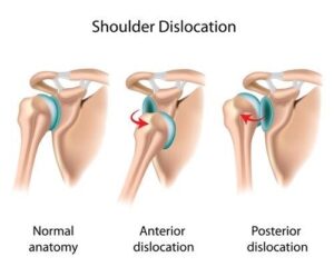 Shoulder Dislocation Surgery Dubai