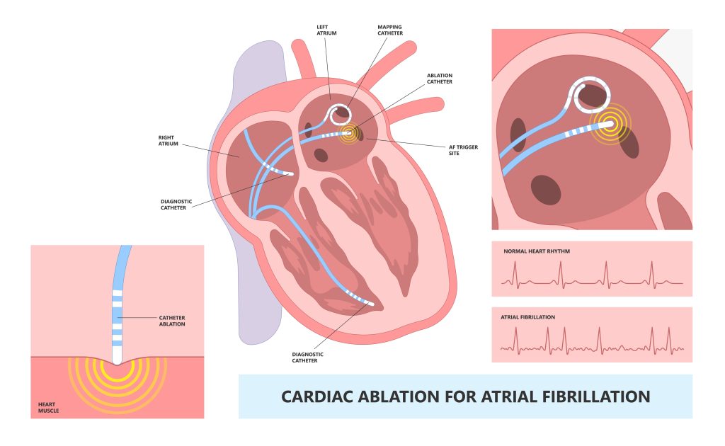Atrial fibrillation af ablation procedure in dubai uae