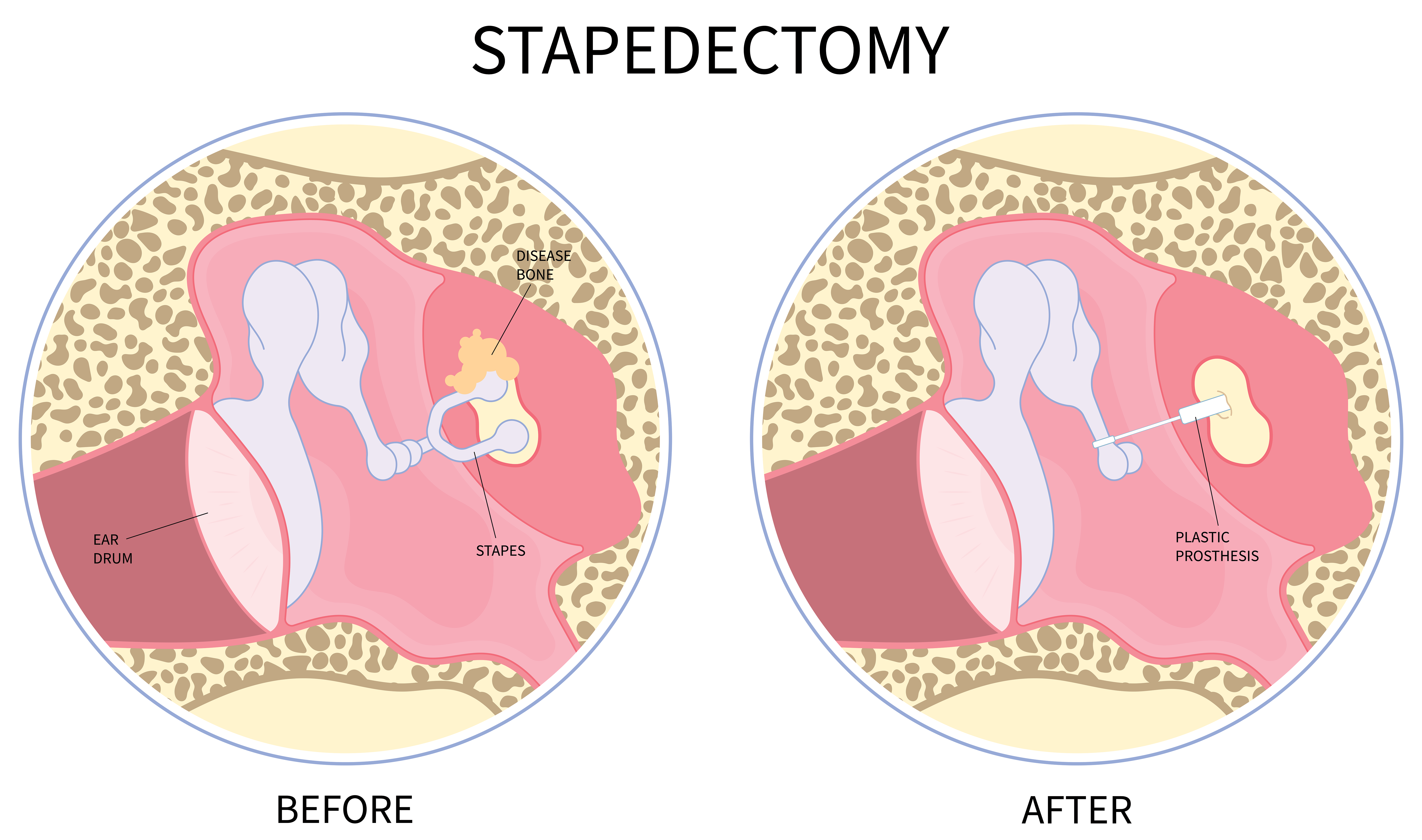 Stapedectomy