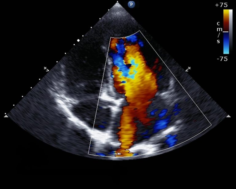 Transthoracic Echocardiography (TTE) Test in Dubai