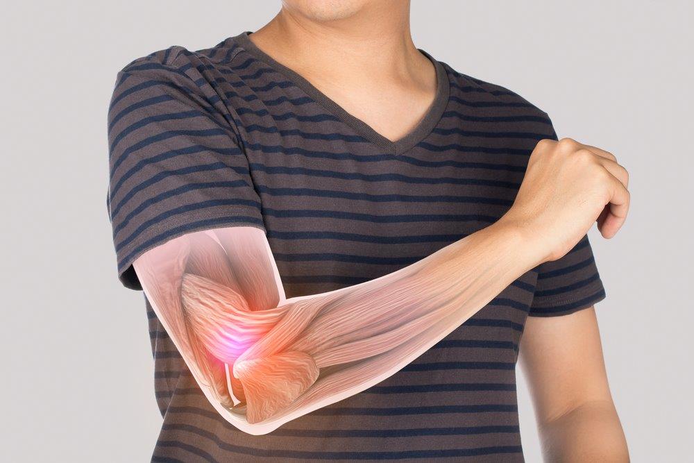 Cubital Tunnel Syndrome