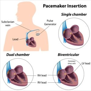Single & Dual Chamber Defibrillator Insertion in Dubai near me