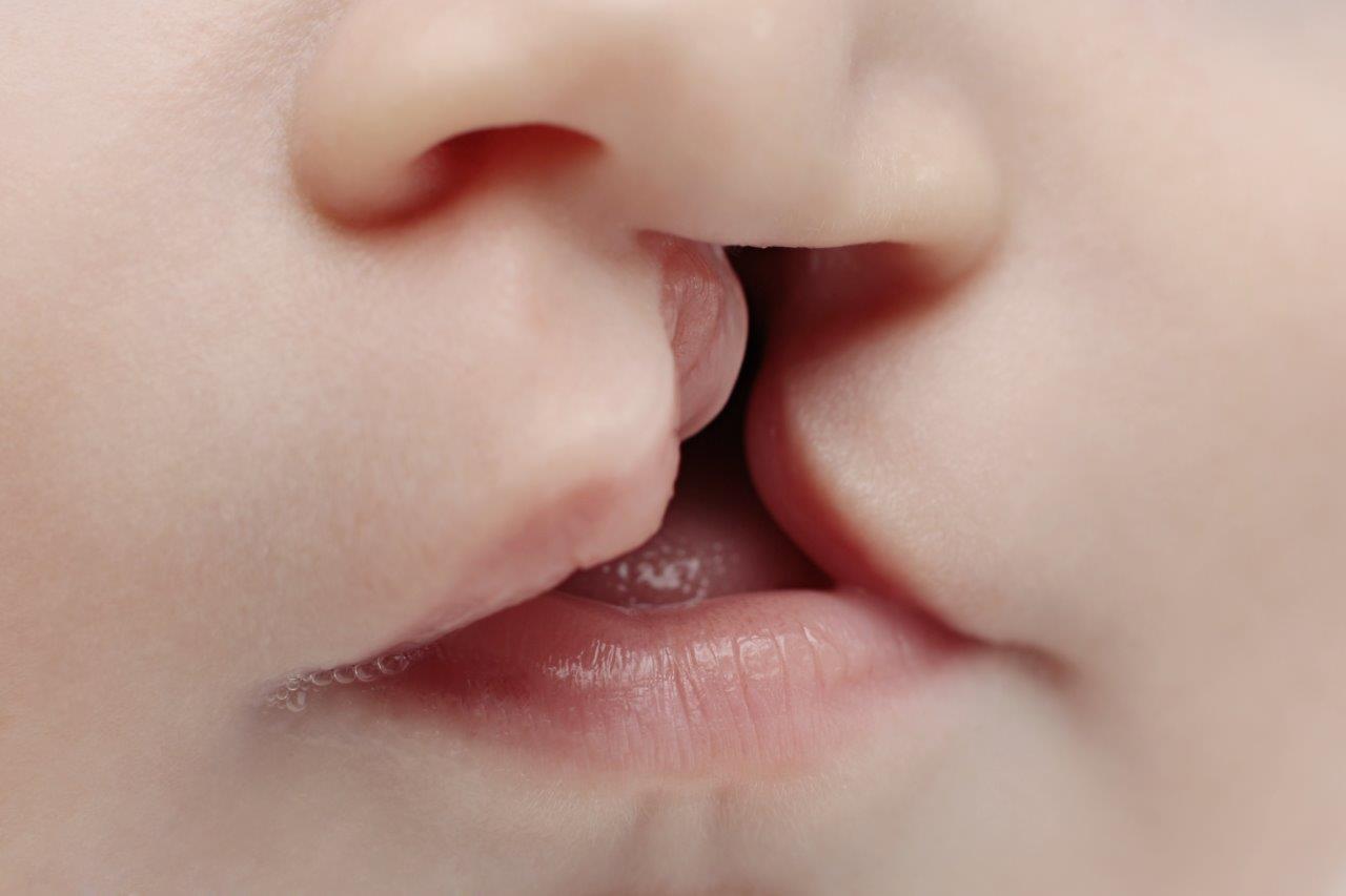 Cleft Lip & Cleft Palate Deformities