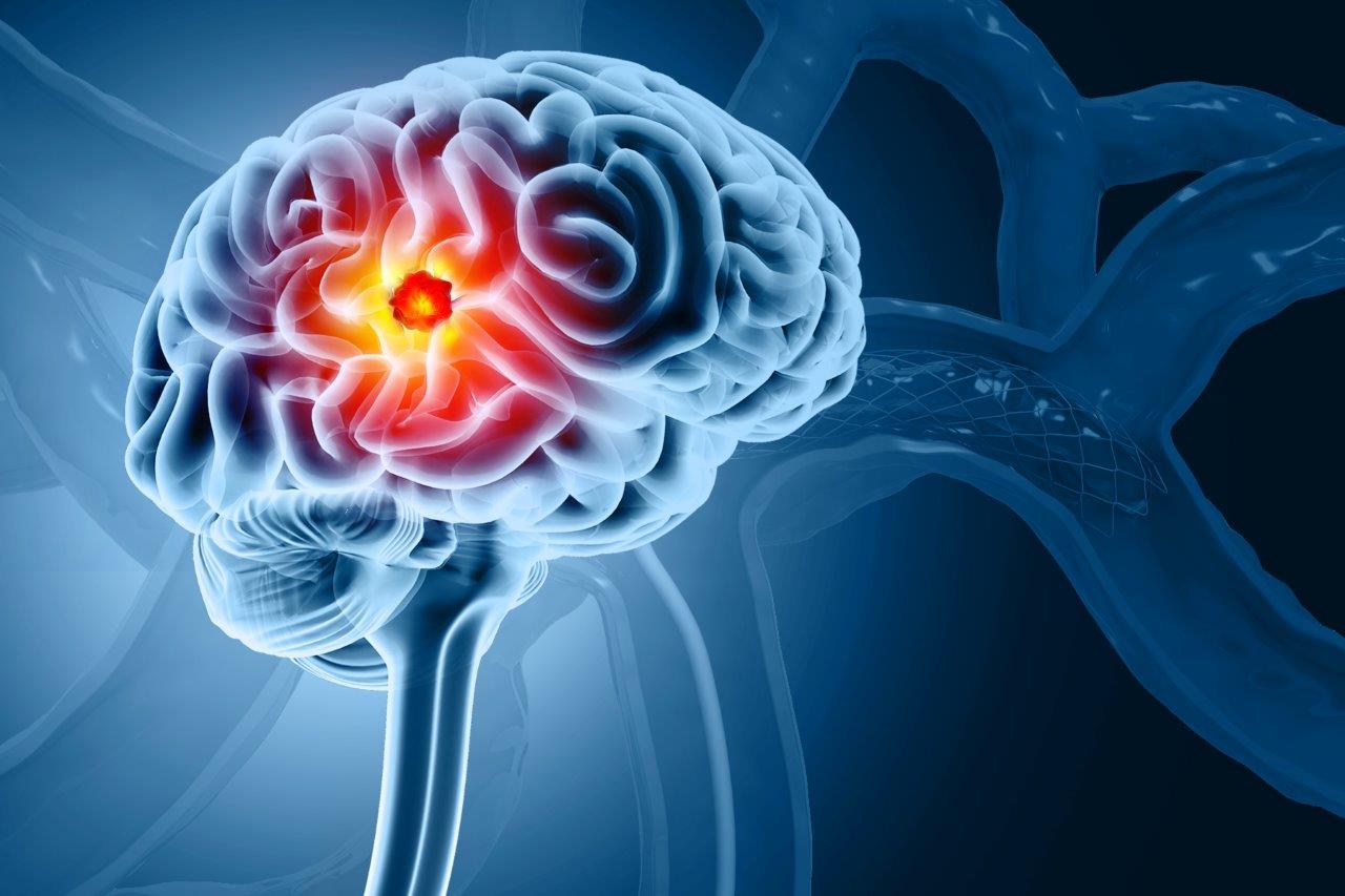 Brain Tumor