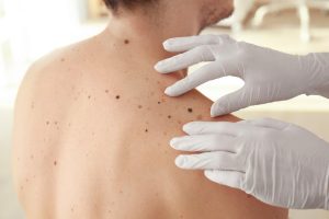 skin cancer screening doctor dubai