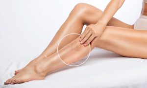 thrombosis symptoms