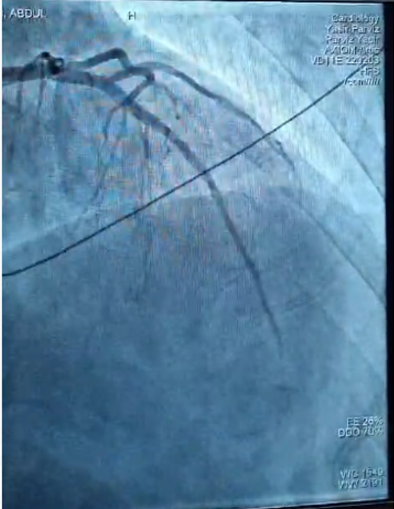 The Widowmaker – Severe blockage in LAD artery