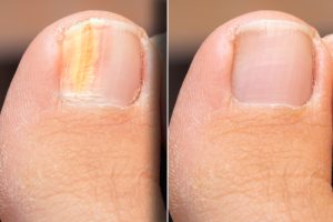 Ingrown Toenails Treatments in Dubai