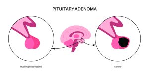 Adenoma Treatments in Dubai