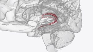 Choroid Plexus Tumor surgery in dubai
