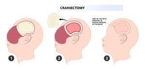 Craniotomy Surgeon in Dubai