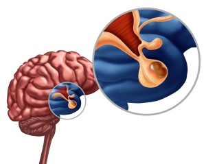 Pituitary Tumor Surgery in Dubai