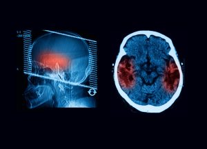 Recovery and Post-Treatment Care for Intracranial Hemorrhages