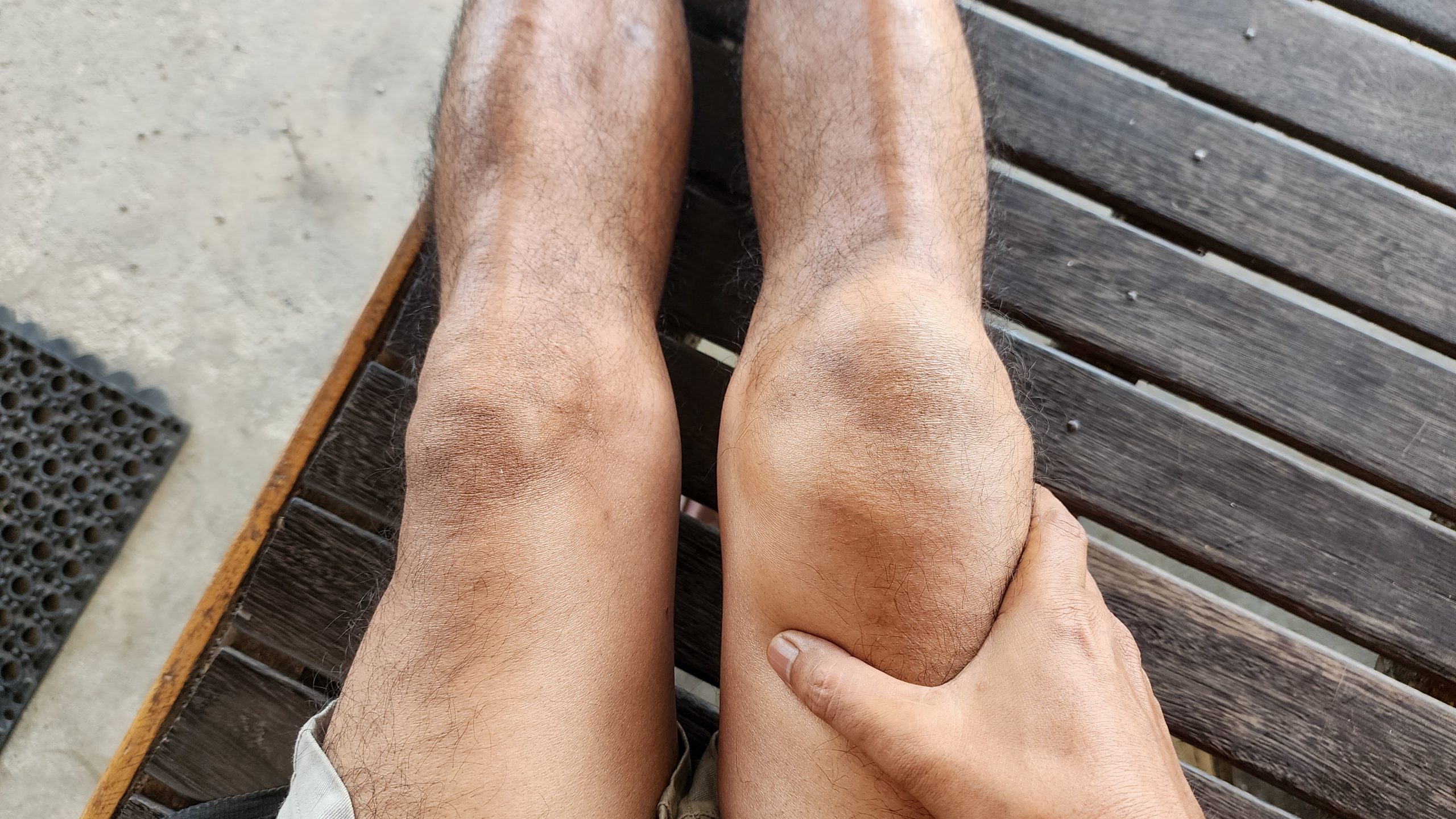 Bruising on the Knee – Causes, Diagnosis, and Treatment
