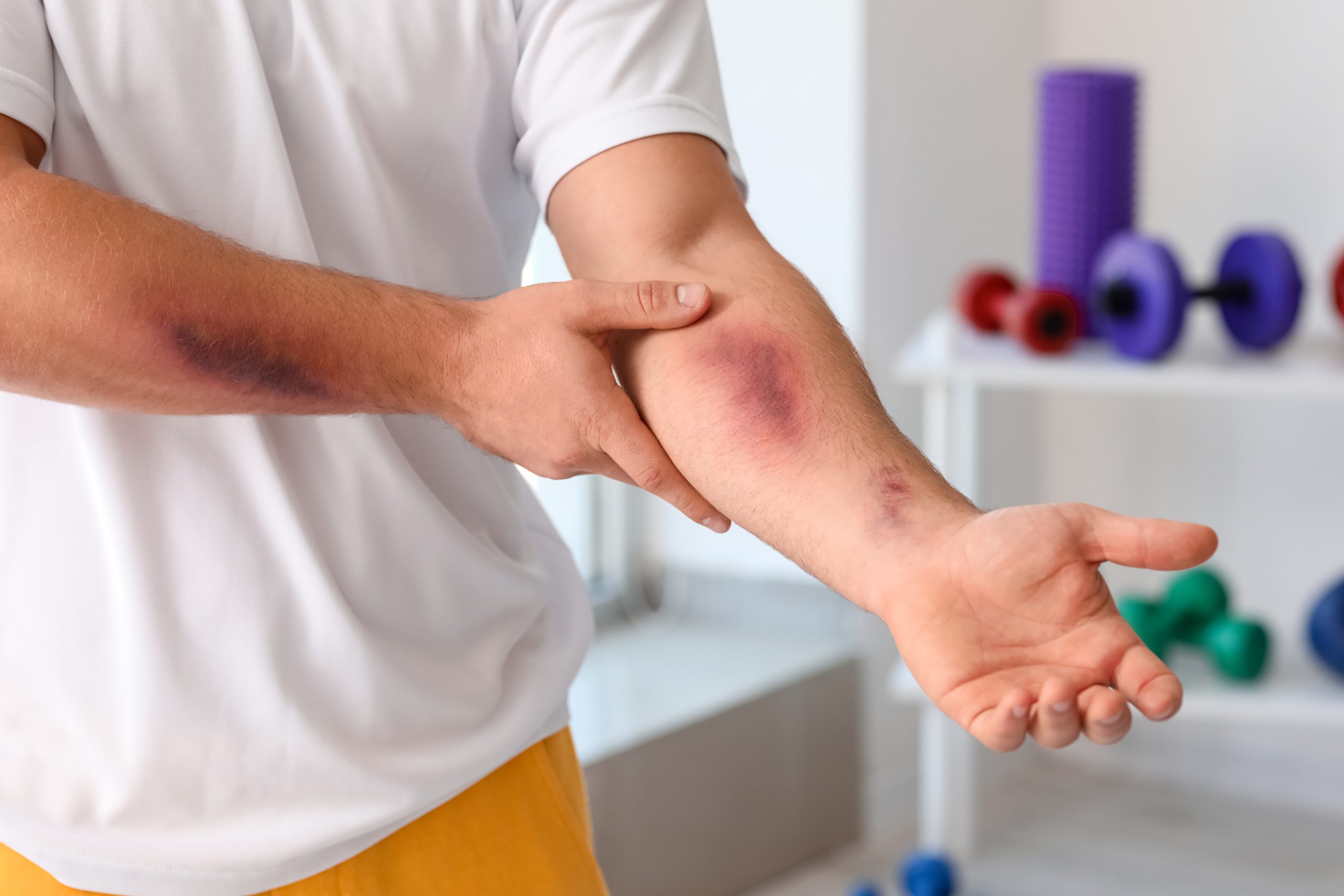 Bleeding and Bruising easily – Causes, Diagnosis and Treatment