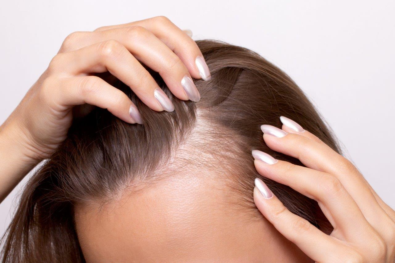 Hair Loss – Causes, Diagnosis and Treatment