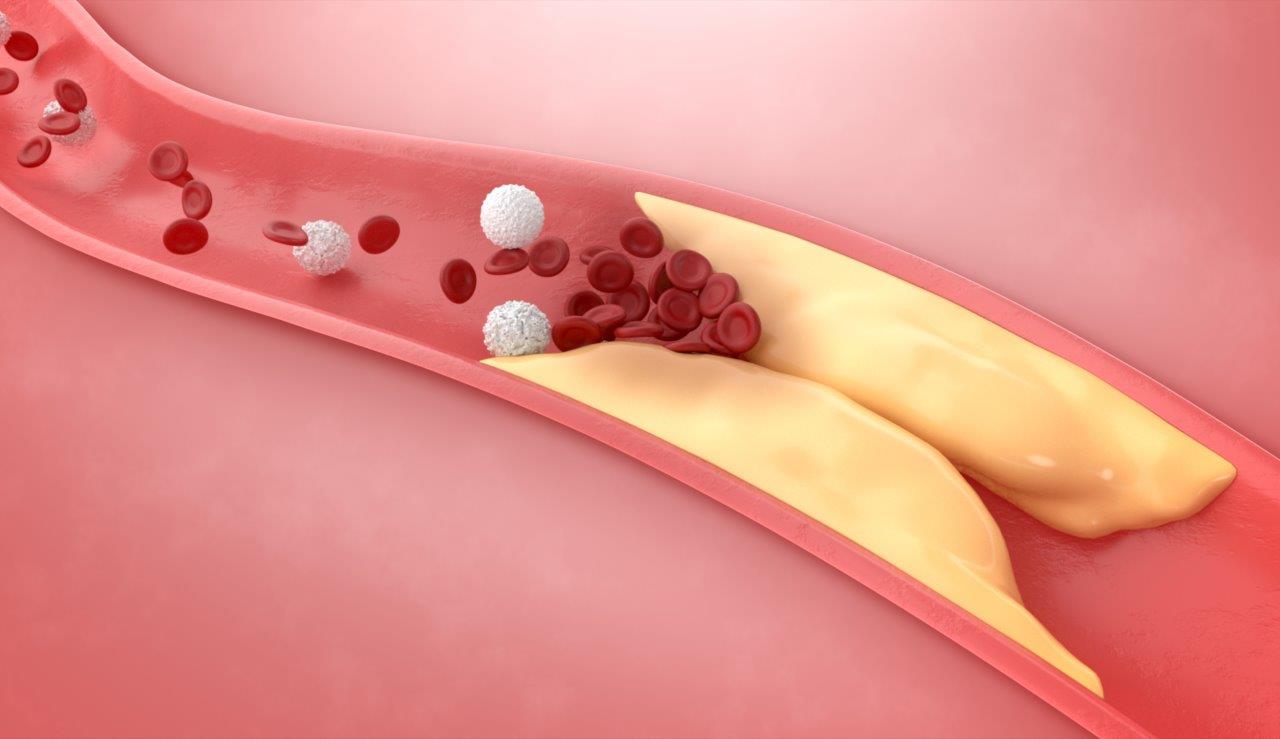 High Cholesterol – Causes, Diagnosis and Treatment