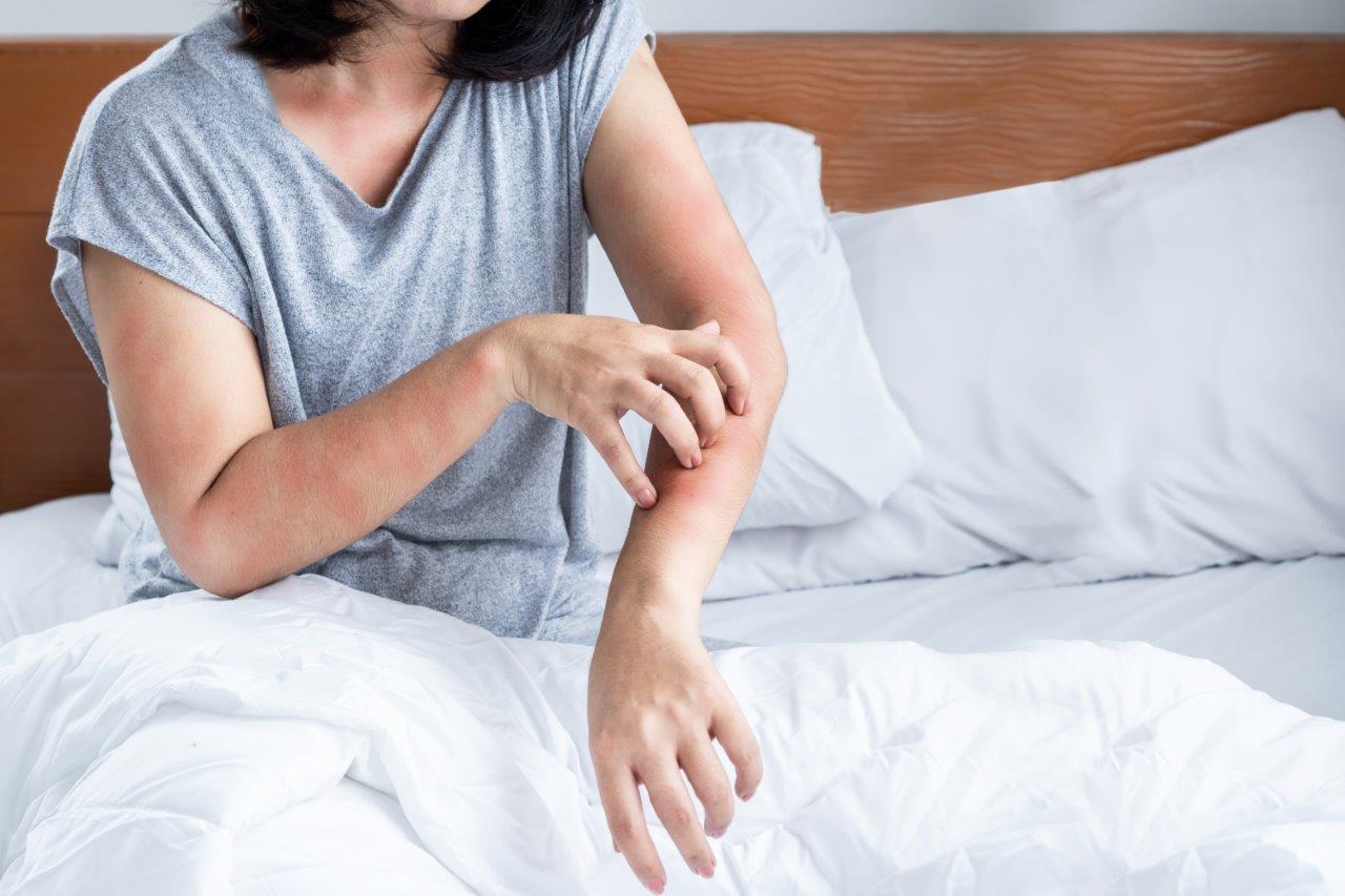 Hives – Causes, Diagnosis and Treatment