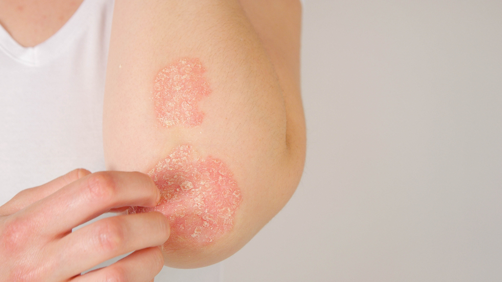 Itchy Rash – Causes, Diagnosis, and Treatment