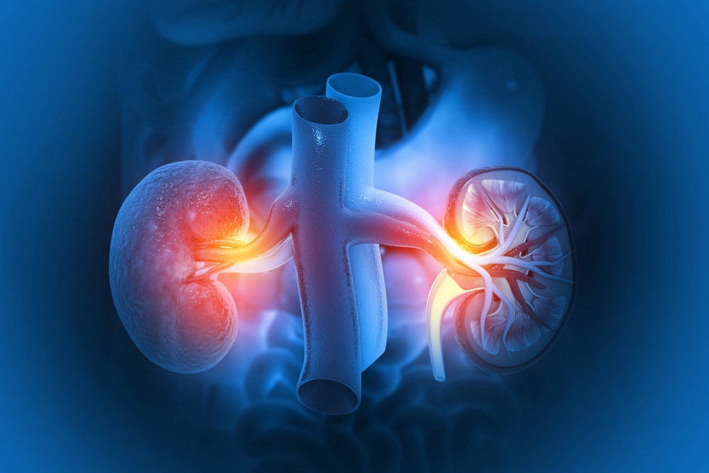 Kidney Stones – Causes, Diagnosis, and Treatment