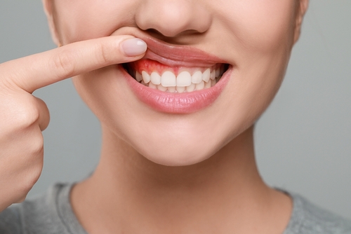 Recurrent Mouth Ulcers: Causes, Diagnosis & Treatment