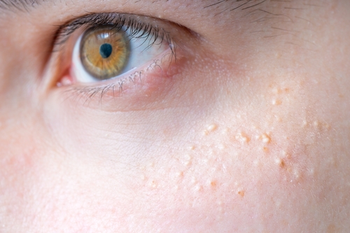 Red or White Raised Bumps: Causes, Diagnosis & Treatment