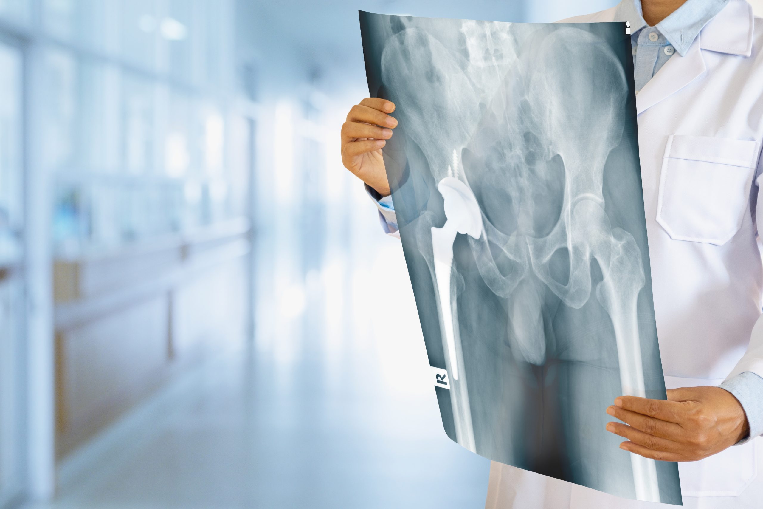 Swelling or stiffness in hip – Causes, Diagnosis & Treatment