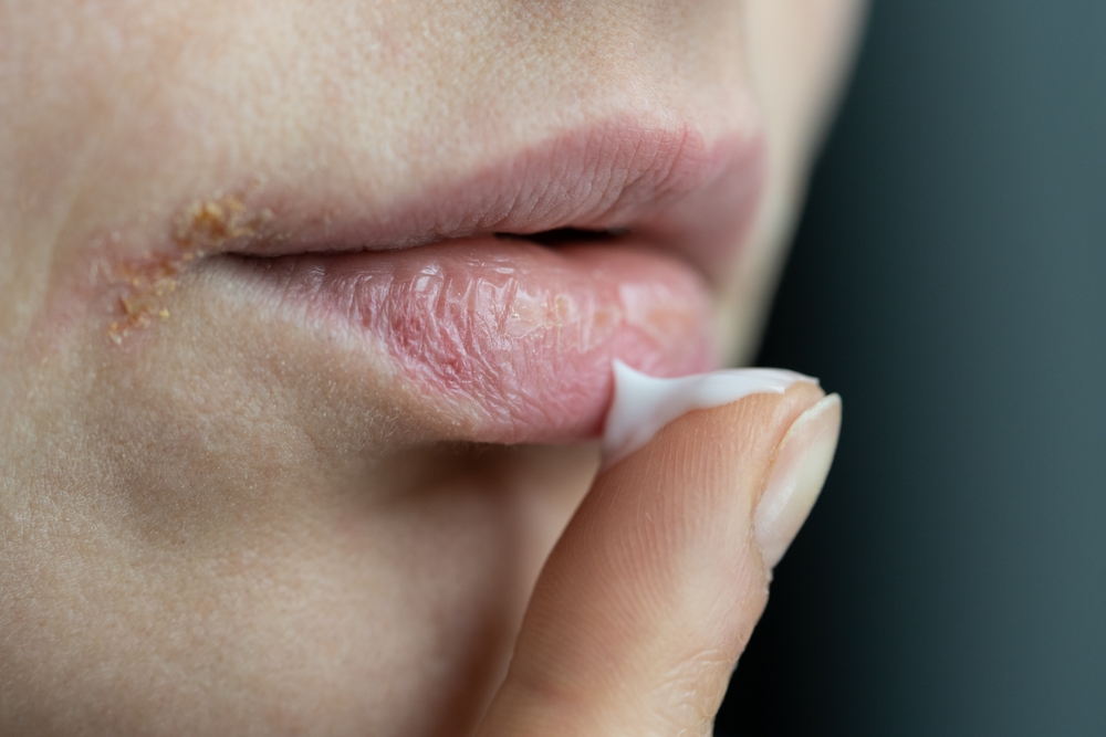 White or Yellowish Patches on the Tongue, Gums, Inner Cheeks, or Roof of the Mouth – Causes, Diagnosis, and Treatments
