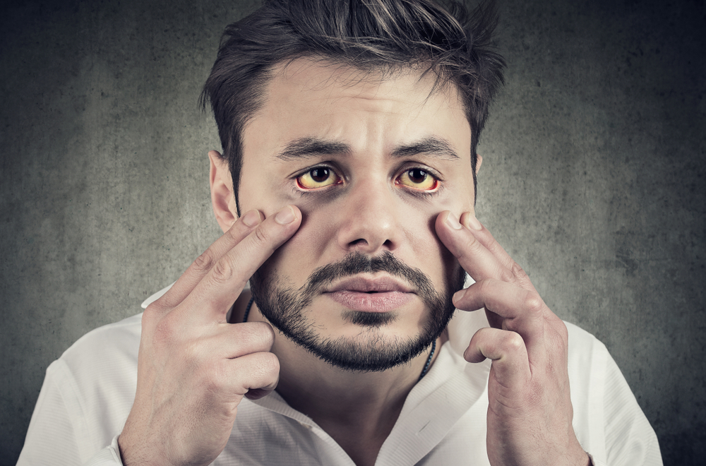Yellowish Skin – Causes, Diagnosis, and Treatments