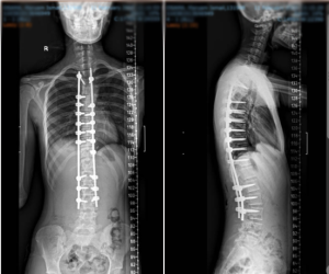 Лечение сколиоза в Дубай - After Images