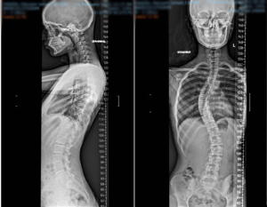Лечение сколиоза в Дубай - Before Images
