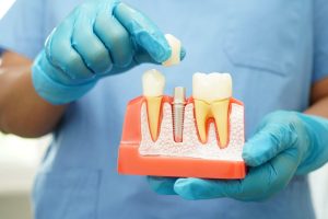 dental implant