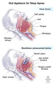 oral-appliance-for-sleep-apnea