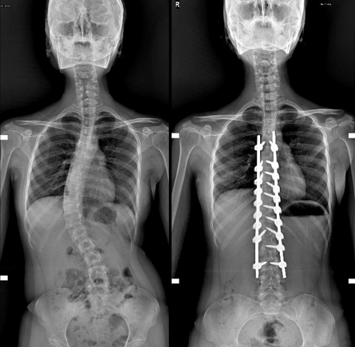 Adolescent Idiopathic Scoliosis Treatment in Dubai – Patient Success Story