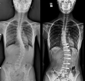 Adolescent Idiopathic Scoliosis VBT Surgery in Dubai