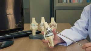 Cost of knee replacement in Dubai