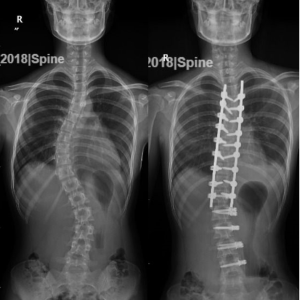 Hybrid Adolescent Idiopathic Scoliosis Treatment in Dubai before and after.jpg