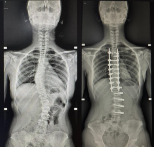 Hybrid Adolescent Idiopathic Scoliosis VBT Surgery in Dubai