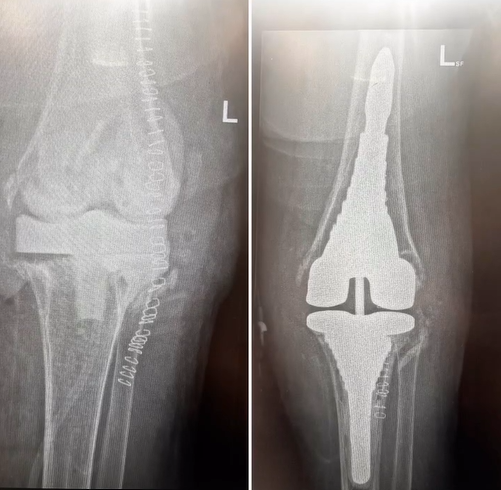 Revision Knee Replacement in Dubai – International Patient from Egypt