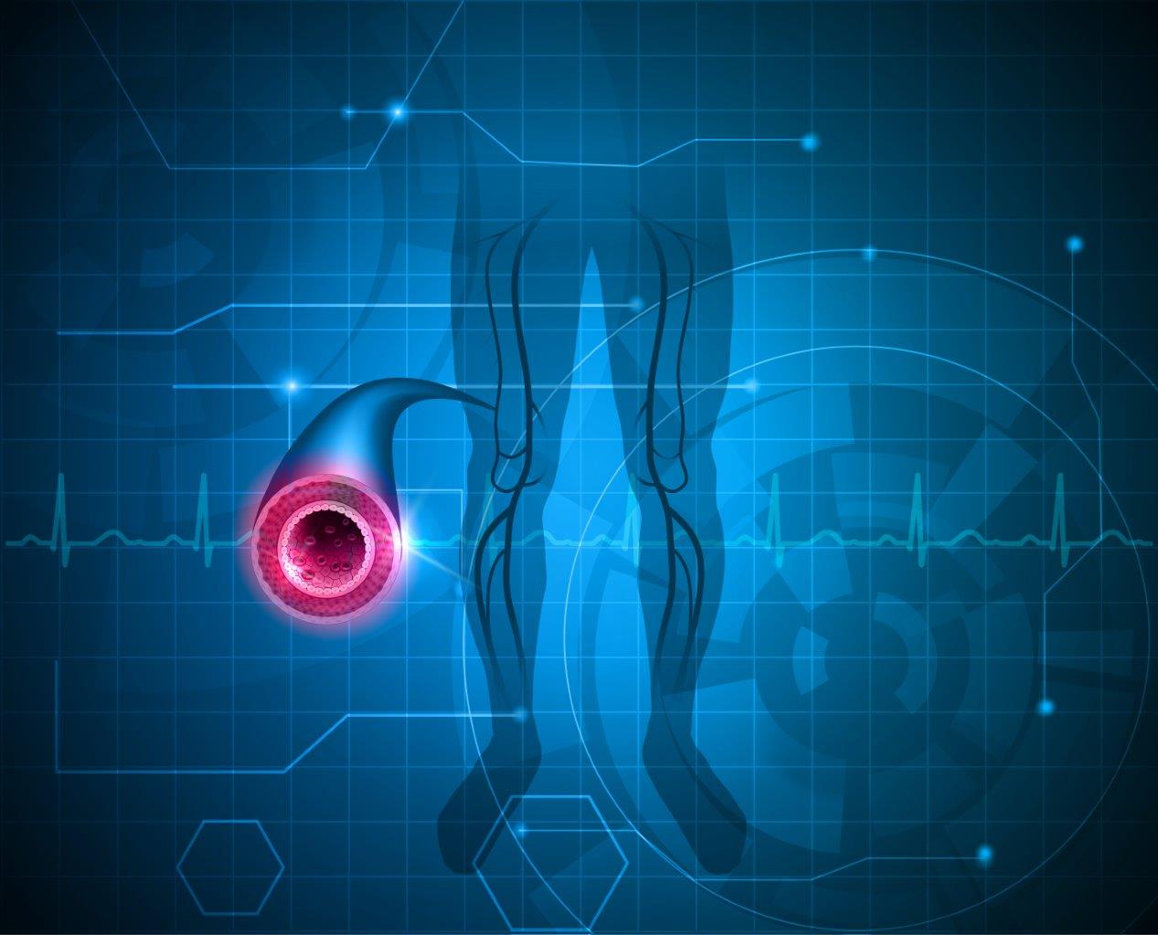 Chronic Venous Insufficiency