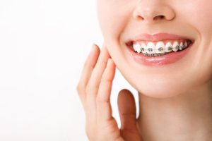 braces in dubai