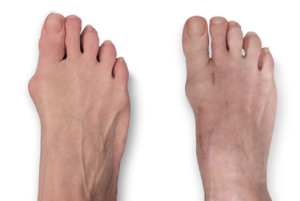 lipiplasty surgery in dubai